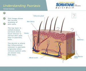 Soriatane Interactive Animation