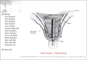 dental implant